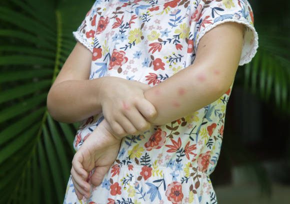 Dermatitis Atopik