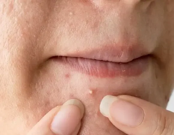 Jerawat, Eksim, atau Psoriasis? Kenali Penyakit Kulit yang Sering Terjadi